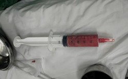 Bệnh viện Trung ương Quân đội 108 cảnh báo những người tiêm filler 5-10 năm trước