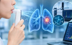Nghiên cứu công nghệ nhận diện nốt phổi có nguy cơ ung thư từ hơi thở