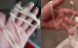 Bác sĩ lấy ra sinh vật dài 4.5m từ cơ thể một người đàn ông, nguyên nhân từ món ăn nhiều người yêu thích
