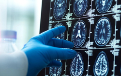 AI lần đầu hỗ trợ mổ não trực tiếp trên người: Cuộc thử nghiệm có thể thay đổi cách bác sĩ phẫu thuật