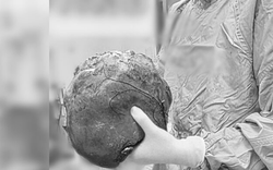 Bác sĩ sững người trước "thứ đáng sợ" trong bụng bệnh nhân
