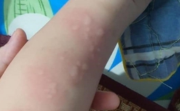 Mẹ run rẩy phát hiện con 15 tháng tuổi nhiễm giun đũa chó và giun lươn