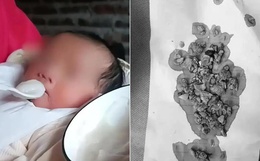 Bé gái 5 tháng tuổi đến viện với chiếc bụng toàn sỏi, bác sĩ kinh hoàng khi biết việc bố mẹ làm từ lúc bé mới sinh 3 ngày
