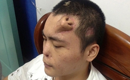 Không phải ảnh lỗi của AI, người đàn ông này đã thực sự mọc một chiếc mũi trên trán: Đó là "tác phẩm" của các bác sĩ Trung Quốc