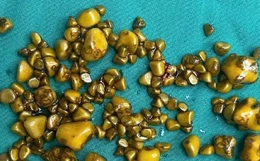 Người phụ nữ "giấu cả trăm cục vàng" trong... túi mật