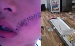 Mở tủ lạnh, bé trai 6 tuổi phải khâu 38 mũi trên mặt