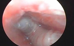 Thấy trẻ bị đau tai kèm chảy máu, gia đình đưa đi khám thì sốc nặng
