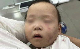 Bé gái 1 tuổi bị bầm tím mặt khi gửi nhà trẻ ở Bắc Ninh: Công an tạm giữ cô giáo