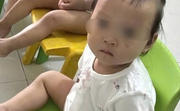 Tình trạng sức khỏe bé gái 1 tuổi bị bầm tím mặt khi gửi nhà trẻ ở Bắc Ninh