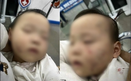 Vụ bé gái bầm tím mặt, có vết răng cắn sau khi đi học mầm non tư thục: Thông tin bất ngờ về cô giáo