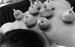 Trào lưu "chích máu chữa đột quỵ" khiến bác sĩ lạnh người