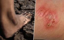 Thái Lan cảnh báo khẩn về dịch "sốt đất": 732 ca nhiễm, 23 trường hợp tử vong