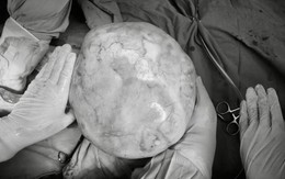 Hy hữu: Bé gái 14 tuổi mang khối u buồng trứng hơn 4kg, bác sĩ cảnh báo những dấu hiệu sớm nhưng hay bị bỏ qua