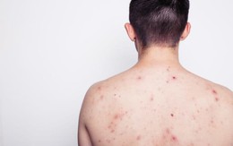 Nam thanh niên 23 tuổi nhiễm HIV sau khi tham gia lễ hội té nước tại Thái Lan