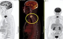 Người đàn ông sốt nhẹ 2 tháng, bác sĩ phát hiện đốt sống cổ bị "đục thủng": Thủ phạm giấu trong căn bếp nhiều gia đình