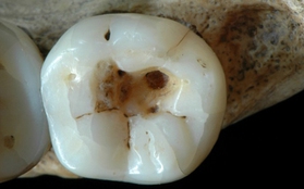 Phương pháp chữa răng "đau chảy nước mắt" của người cổ đại 