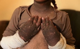 Bàng hoàng với làn da của cô bé 5 tuổi sau vụ tấn công hóa học của IS