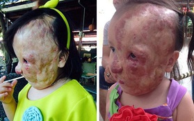 Bé gái 5 tuổi mang khối u che hết nửa gương mặt bất ngờ được một người xa lạ cứu sống