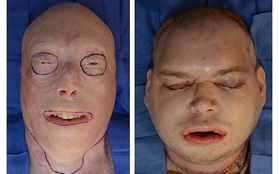 Cấy ghép mặt thành công cho người lính cứu hỏa bị lửa hủy hoại toàn bộ gương mặt