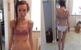 Cô gái suýt chết vì điên cuồng giảm cân để có được thân hình giống người mẫu Kendall Jenner