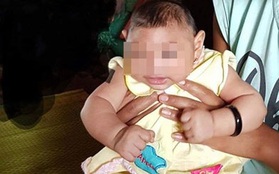 Bé gái 4 tháng tuổi ở Đắk Lắk bị dị tật do virus Zika
