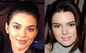 Kendall Jenner cũng đã tiếp bước Kylie đến thẩm mỹ viện bơm môi rồi sao?