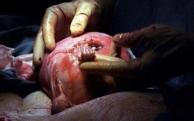 Thai nhi 21 tuần tuổi trong bức ảnh nắm chặt ngón tay bác sĩ gây chấn động thế giới giờ ra sao?