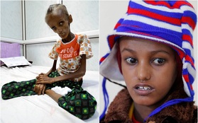 Cô gái Yemen 18 tuổi với thân hình còi cọc đến mức khó tin đã có thể mỉm cười trở lại