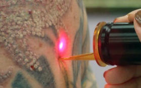 Điều gì sẽ xảy ra khi bạn dùng laser để xóa hình xăm?