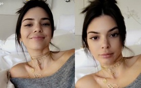 Phủ nhận thẩm mỹ, nhưng Kendall Jenner vẫn lộ môi sưng vù bất thường