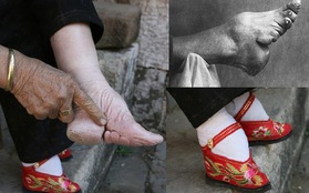 "Bó chân gót sen": Khi cái giá của sắc đẹp là những đôi chân rỉ máu và biến dạng cả đời