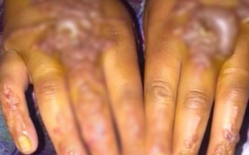 Cô gái bị phồng rộp tay nặng nề do dị ứng mực xăm henna