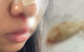 Cô gái suýt tắc thở vì bác sĩ thẩm mỹ quên lấy băng gạc trong mũi bệnh nhân
