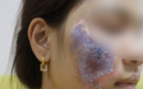 Hà Nội: Dùng kem trộn, một phụ nữ bị "lột sạch" da mặt, mất hàng trăm triệu điều trị nhưng chỉ phục hồi được 30-40%