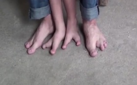 Đôi chân như cặp càng cua của bé trai hai ngón