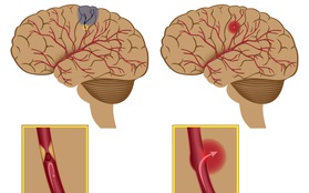 Đột quỵ não ngày càng trẻ hóa chỉ vì 6 nguyên nhân người trẻ nào cũng mắc phải