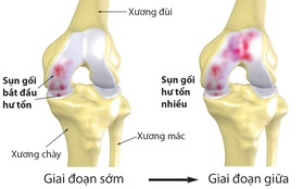 6 căn bệnh nguy hiểm mà người thừa cân, béo phì có nguy cơ cao mắc phải