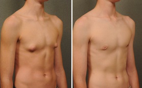 Cơ thể thiếu loại hormone này, ngực nam giới có thể phát triển to giống nữ giới