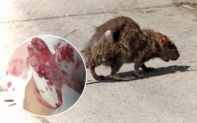 Cô bé 14 tuổi bị đàn chuột hung dữ cắn hơn 200 vết kín cơ thể trong lúc ngủ say