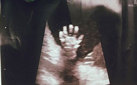 Nằm trong bụng mẹ, thai nhi 20 tuần tuổi giơ bàn tay năm ngón vẫy chào