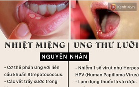 Cẩn thận với các nốt nhiệt miệng bởi có thể đó chính là ung thư lưỡi