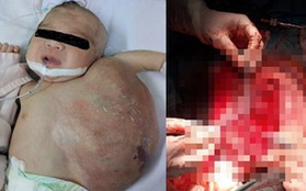 TP.HCM: Vừa chào đời, bé gái đã mang khối u khủng trên cơ thể khiến tính mạng nguy hiểm