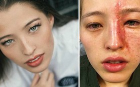 Chỉ vì bất cẩn khi dùng máy xông hơi tinh dầu, cô gái trẻ này đã bị bỏng nặng trên gương mặt