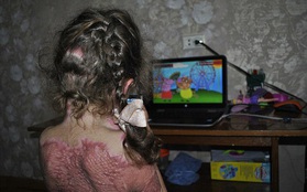 Cảnh báo: Trò chơi trực tuyến khiến bé gái 5 tuổi bị bỏng nặng, toàn thân biến dạng