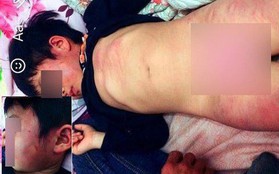 Bắc Giang: Gia đình tố cô giáo đánh con bầm tím toàn thân khi đi học ở trường