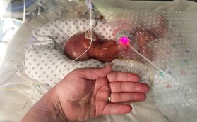 Em bé hạt tiêu nặng 0,5kg chỉ nhỉnh hơn bàn tay người lớn