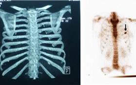 Cắt bỏ xương sườn - có đáng đánh đổi để sở hữu "vòng eo 56" đầy đau đớn?