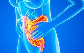 Những biện pháp điều trị bệnh Crohn - bệnh viêm ruột đơn giản mà hiệu quả tại nhà