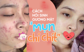 Hãy xem cách cô bạn này cứu làn da của mình thoát khỏi thảm hoạ "mụn chi chít" do dị ứng kem trộn