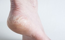 Thấy gót chân bị nứt nẻ nghiêm trọng có thể là do những nguyên nhân sau đây gây ra